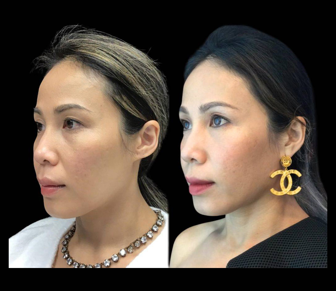 37-year-old-female-ultratherapy-before-and-after-1.jpg