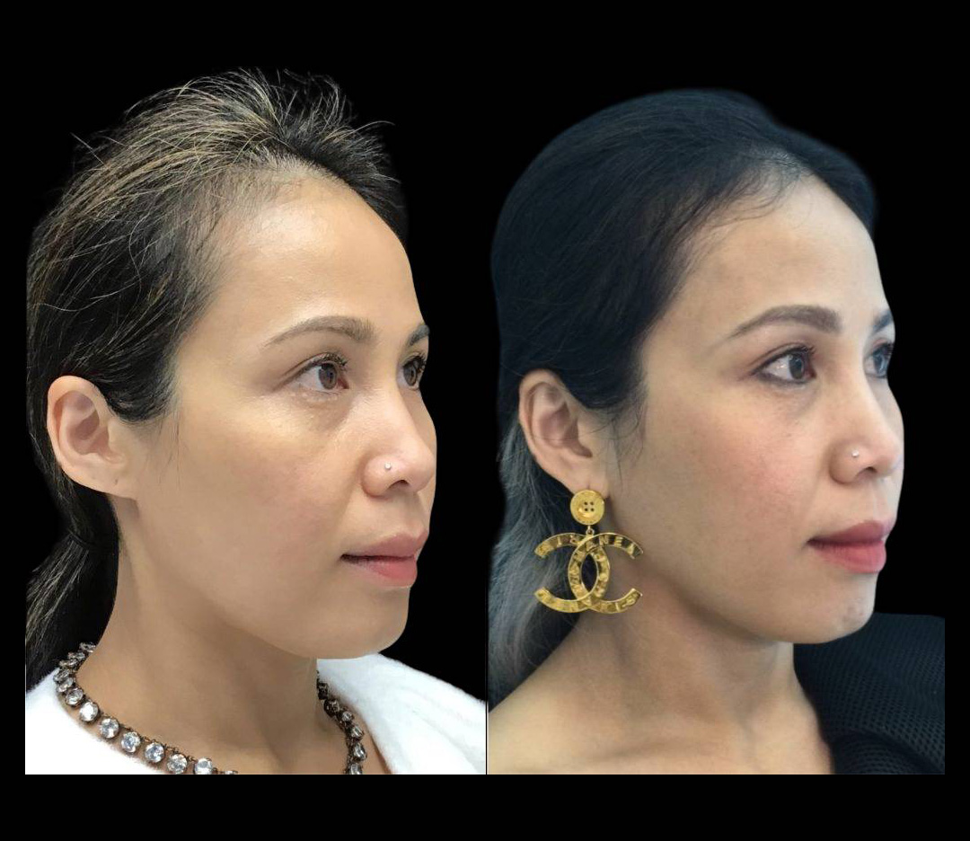 37-year-old-female-ultratherapy-before-and-after-3.jpg