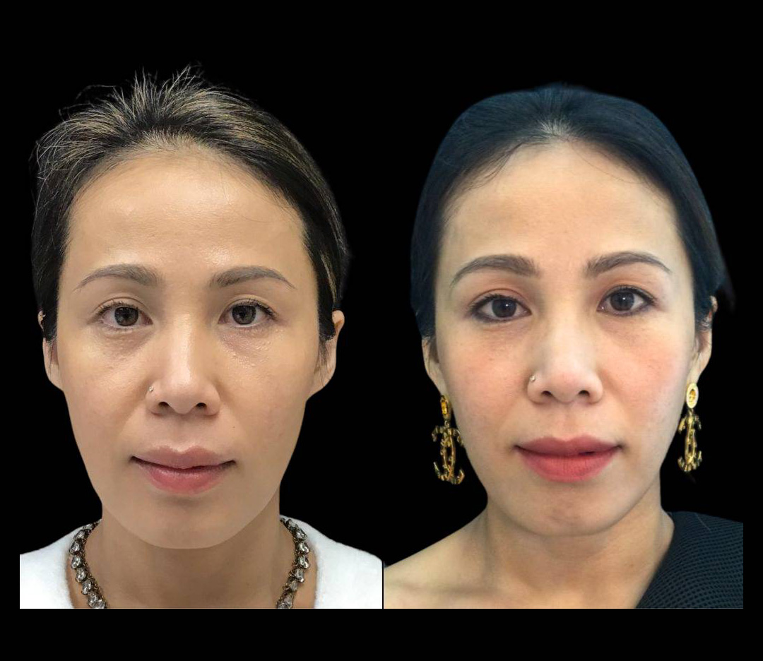 37-year-old-female-ultratherapy-before-and-after.jpg