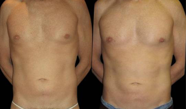 37-year-old-male-breast-reduction-before-and-after-front-view-9107.jpg
