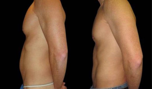 37-year-old-male-breast-reduction-before-and-after-side-view.jpg