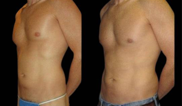 37-year-old-male-breast-reduction-before-and-after-three-quarter-view.jpg