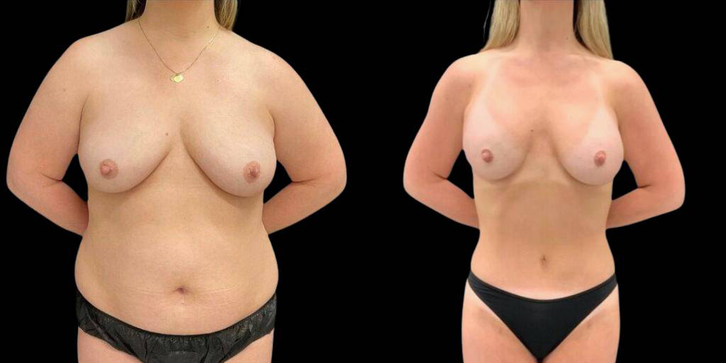 38-year-old-female-breast-augmentation-and-implant-before-and-after-front-view.jpg