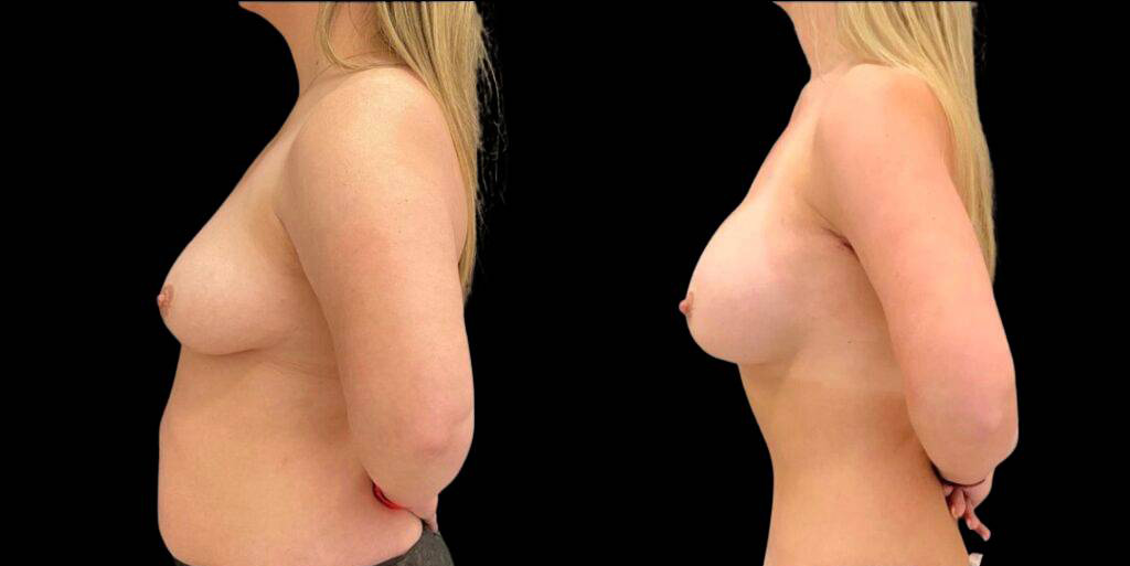 38-year-old-female-breast-augmentation-and-implant-before-and-after-side-view-30845.jpg