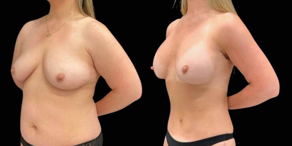 38-year-old-female-breast-augmentation-and-implant-before-and-after-three-quarters-view-1.jpg
