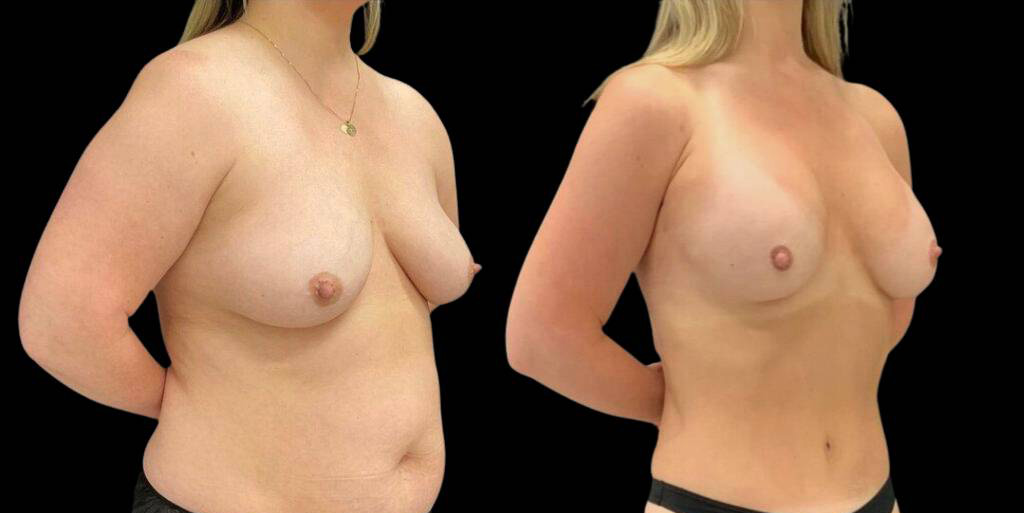 38-year-old-female-breast-augmentation-and-implant-before-and-after-three-quarters-view-2.jpg