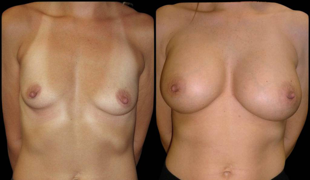 38-year-old-female-breast-implant-exchange-before-and-after-front-view.jpg