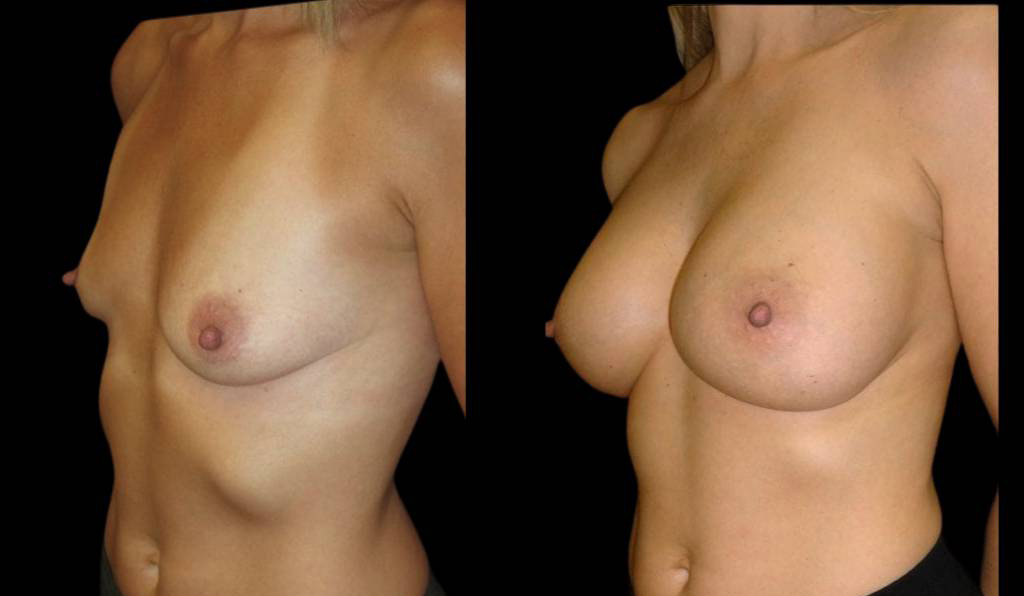 38-year-old-female-breast-implant-exchange-before-and-after-three-quarter-view.jpg