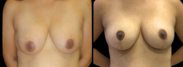 This is a 38-year-old female that has had an arm lift after weight loss showing the before and after's side-by-side