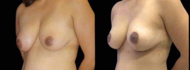 This is a 38-year-old female that has had an arm lift after weight loss showing the before and after's side-by-side