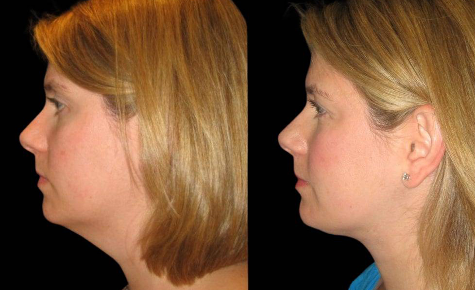 38-year-old-female-necklift-before-and-after-side-view.jpg
