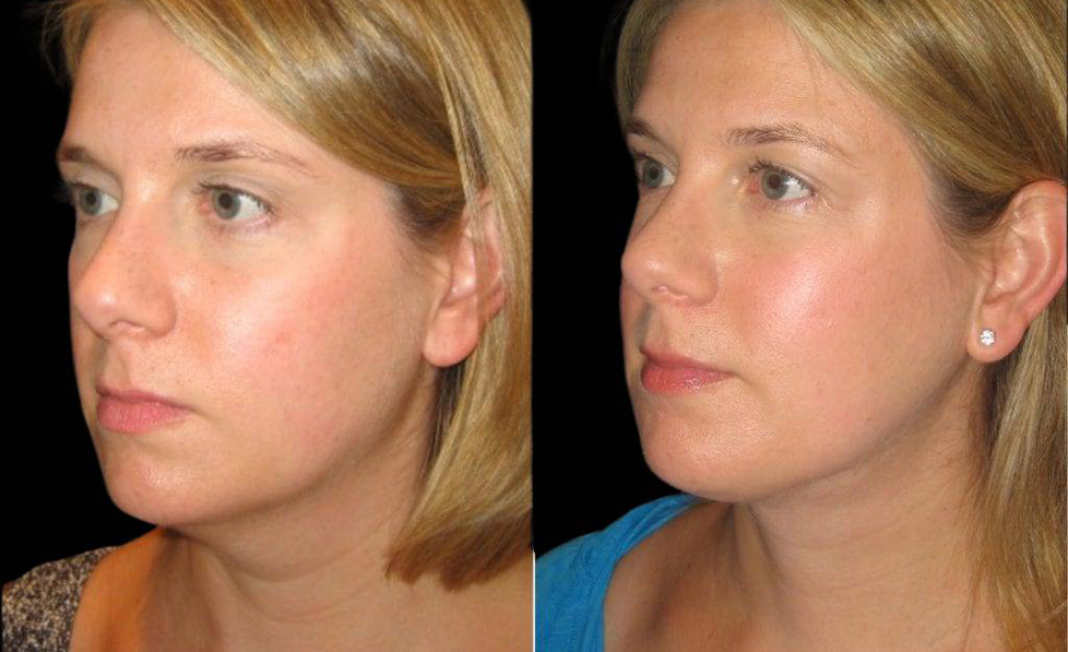 38-year-old-female-necklift-before-and-after-three-quarter-view-8791.jpg