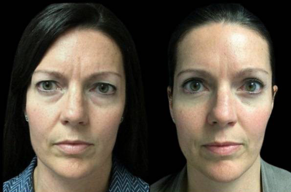 38-year-old-female-upper-and-lower-eyelid-lift-before-and-after-front-view-.jpg