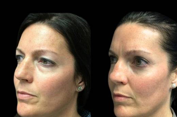 38-year-old-female-upper-and-lower-eyelid-lift-before-and-after-three-quarter-view.jpg