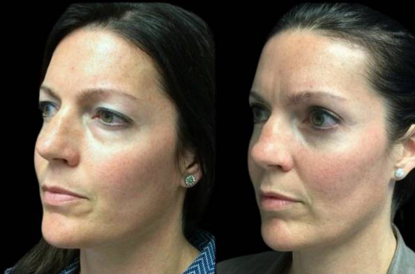 38-year-old-female-upper-and-lower-eyelid-lift-before-and-after-three-quarters-view-.jpg