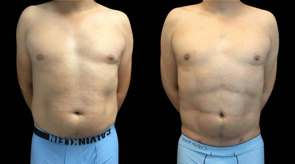 This is a 38-year-old male that has had an abdominal etching done showing the before and after's side-by-side
