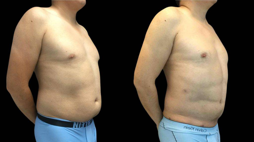 This is a 38-year-old male that has had an abdominal etching done showing the before and after's side-by-side