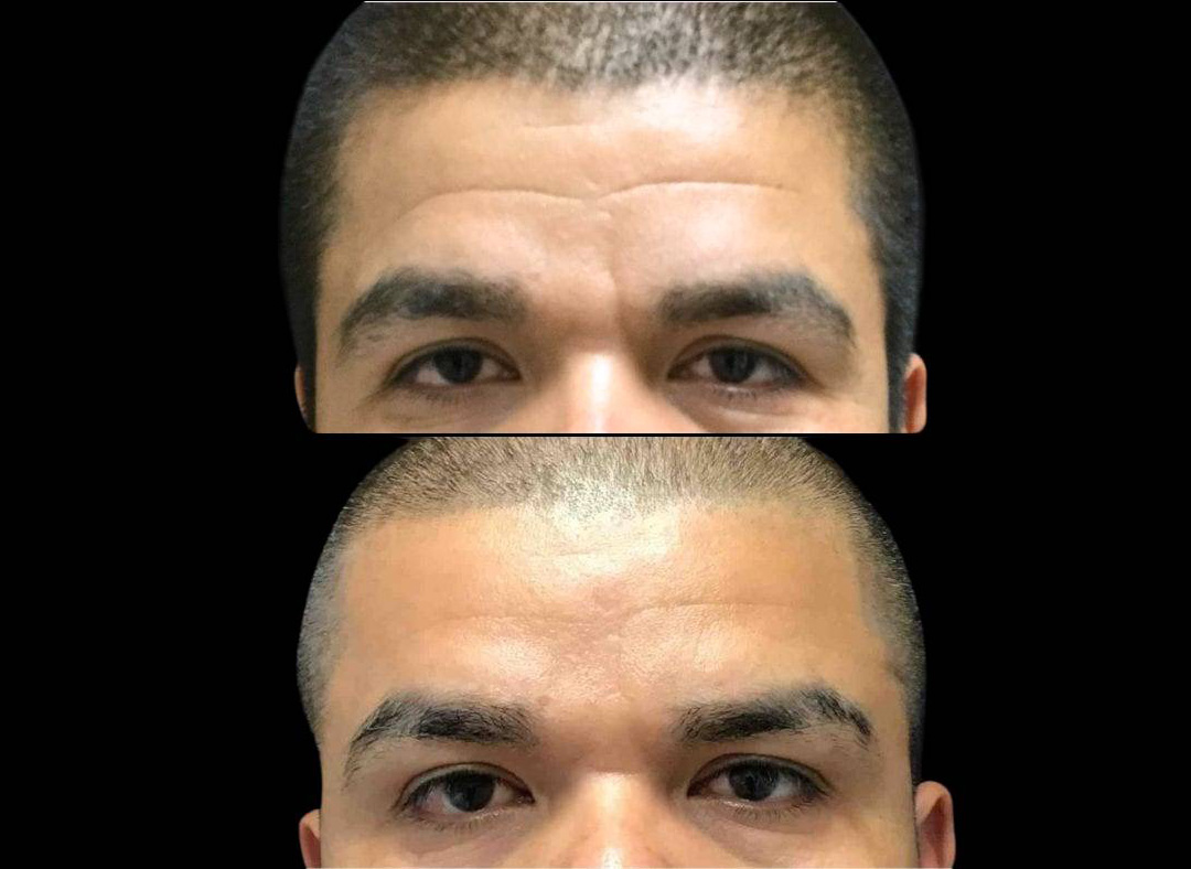 38-year-old-male-botox-before-and-after.jpg