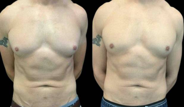 38-year-old-male-breast-reduction-before-and-after-front-view-20594.jpg