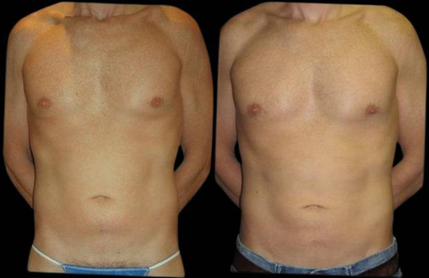 38-year-old-male-laser-lipo-before-and-after-front-view.jpg