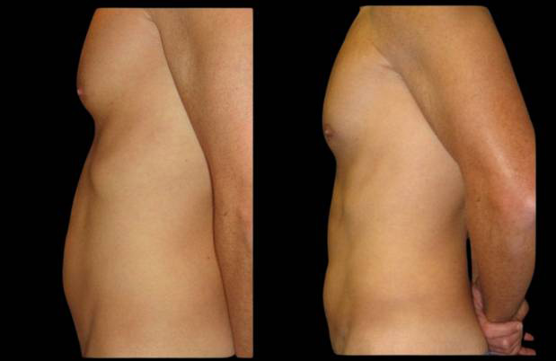 38-year-old-male-laser-lipo-before-and-after-side-view.jpg