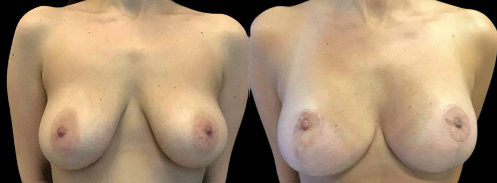 This is a 39-year-old female that has had a breast lift showing the before and after's side-by-side