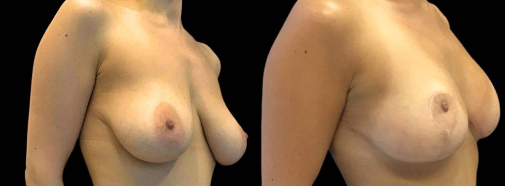 This is a 39-year-old female that has had a breast lift showing the before and after's side-by-side