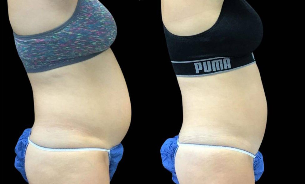 39-year-old-female-coolsculpting-before-and-after-side-view-1-1.jpg