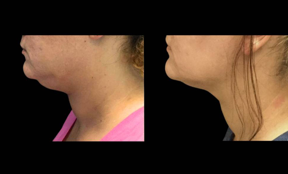 39-year-old-female-coolsculpting-before-and-after-side-view-2.jpg