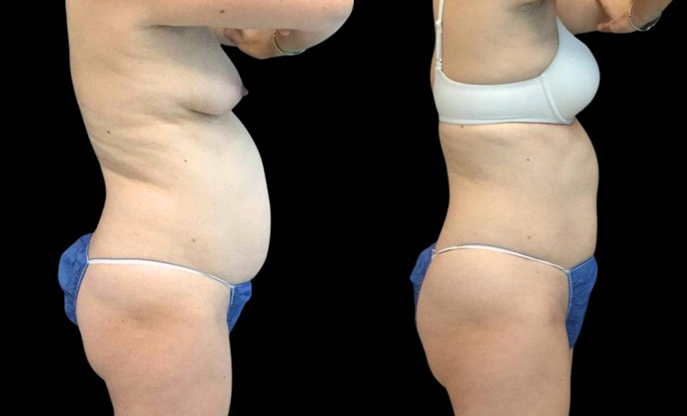 39-year-old-female-coolsculpting-before-and-after-side-view.jpg