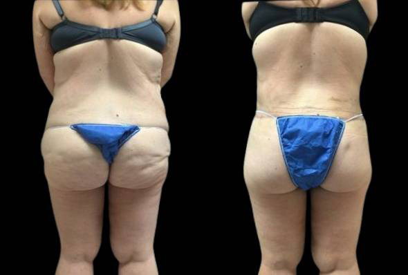 39-year-old-female-lower-body-lift-before-and-after-back-view.jpg