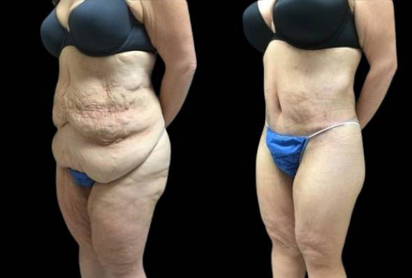 39-year-old-female-lower-body-lift-before-and-after-three-quarter-view.jpg