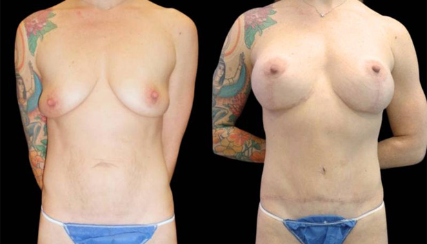 39-year-old-female-mommy-makeover-body-before-and-after-front-view-1.jpg