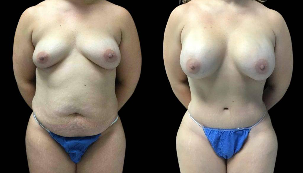 39-year-old-female-mommy-makeover-body-before-and-after-front-view-28385.jpg