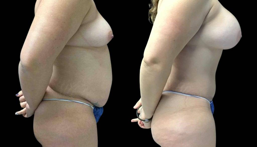 39-year-old-female-mommy-makeover-body-before-and-after-side-view-1.jpg