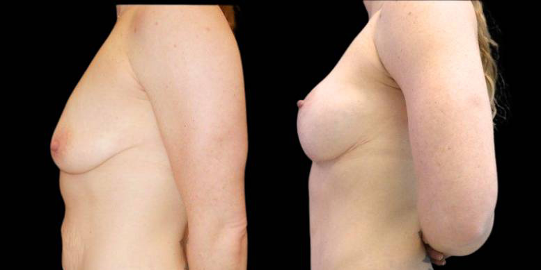 39-year-old-female-mommy-makeover-body-before-and-after-side-view-2.jpg