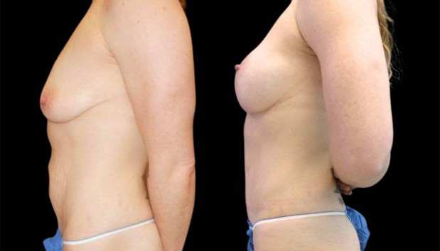 39-year-old-female-mommy-makeover-body-before-and-after-side-view-2.jpg