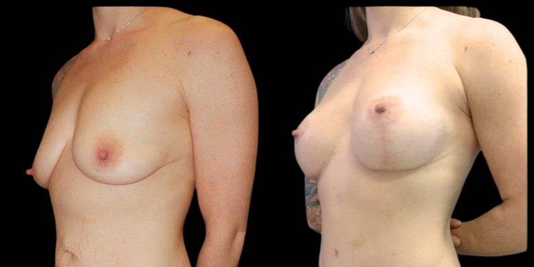39-year-old-female-mommy-makeover-body-before-and-after-three-quarters-view-12465.jpg