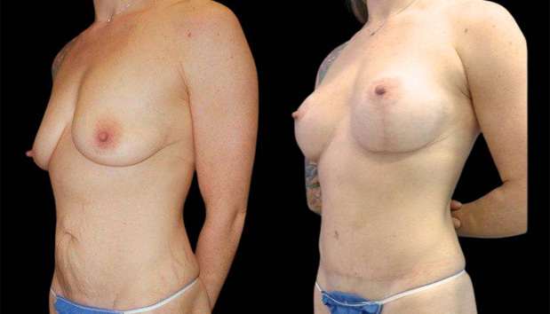 39-year-old-female-mommy-makeover-body-before-and-after-three-quarters-view-12465.jpg