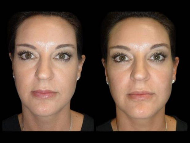 39-year-old-female-non-surgical-cheek-augmentation-before-and-after-1.jpg
