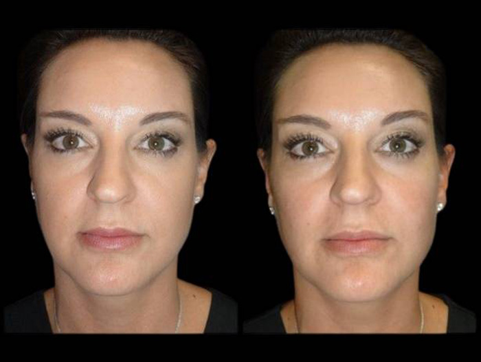 39-year-old-female-non-surgical-cheek-augmentation-before-and-after-1.jpg