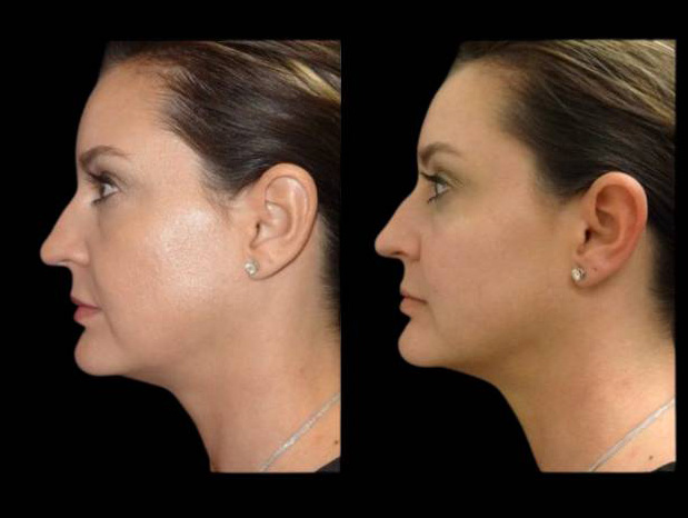39-year-old-female-non-surgical-cheek-augmentation-before-and-after-2.jpg
