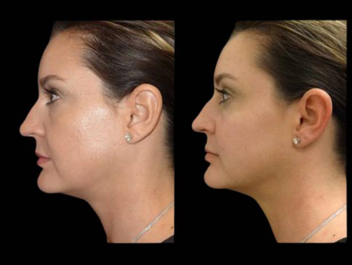 39-year-old-female-non-surgical-cheek-augmentation-before-and-after-2.jpg