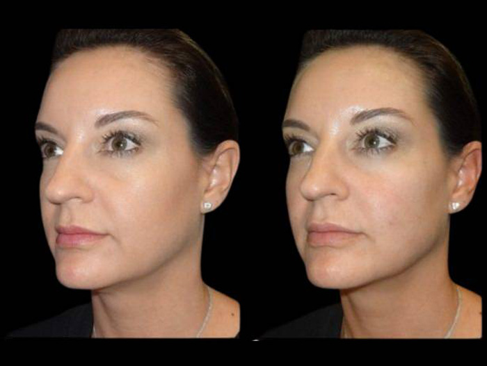 39-year-old-female-non-surgical-cheek-augmentation-before-and-after.jpg