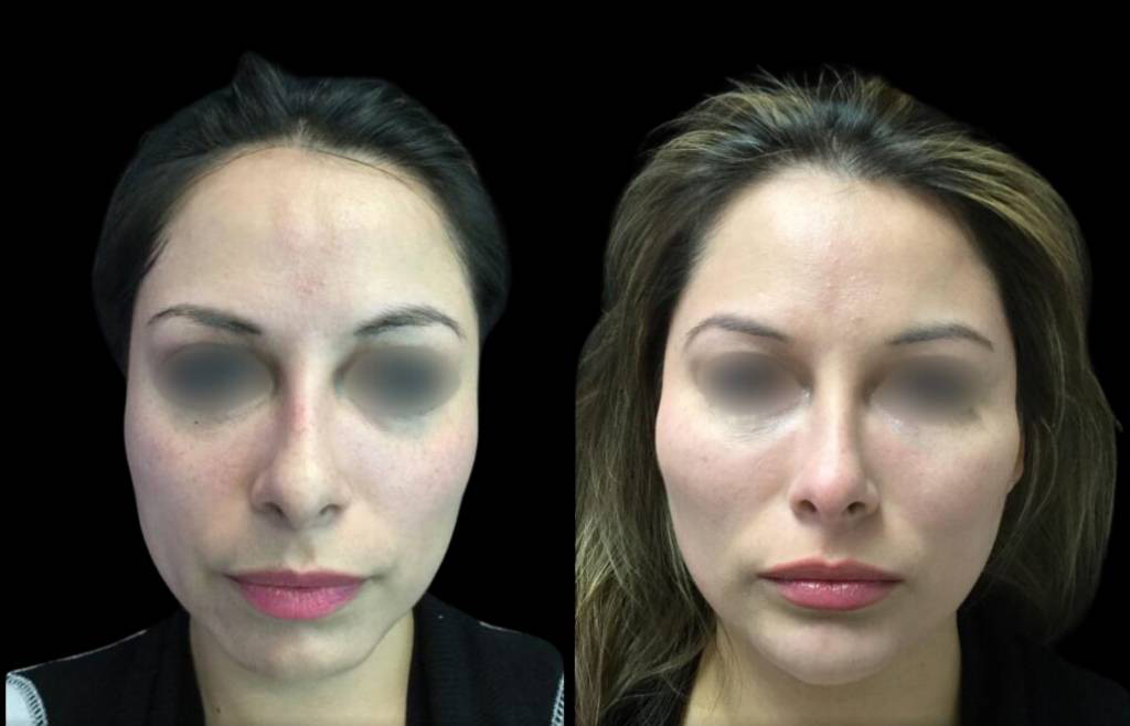 39-year-old-female-non-surgical-chin-augmentation-before-and-after-front-view.jpg