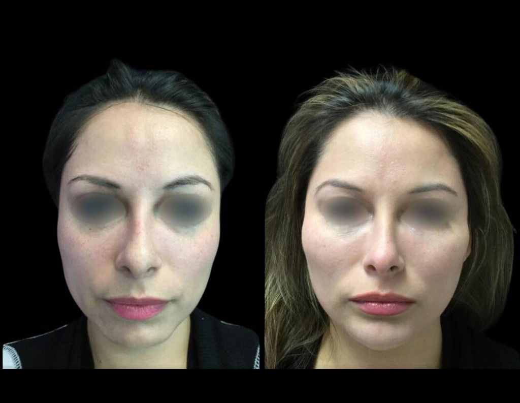 39-year-old-female-non-surgical-chin-augmentation-before-and-after-front-view.jpg