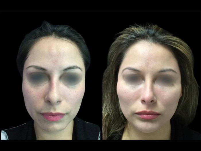 39-year-old-female-non-surgical-chin-augmentation-before-and-after-front-view.jpg