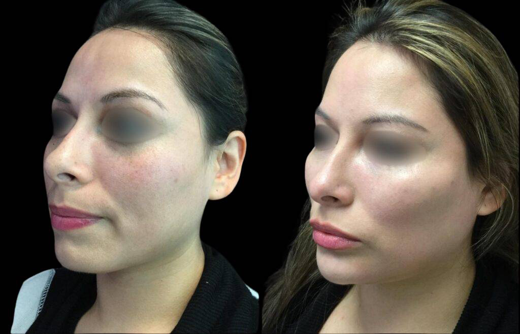 39-year-old-female-non-surgical-chin-augmentation-before-and-after-three-quarter-view-17073.jpg