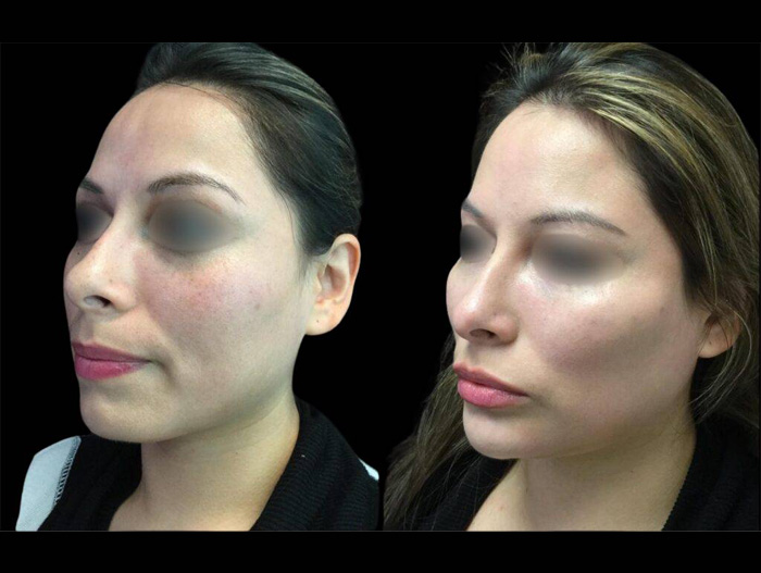 39-year-old-female-non-surgical-chin-augmentation-before-and-after-three-quarter-view-17073.jpg