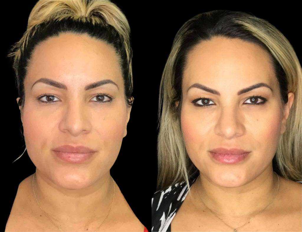 39-year-old-female-radiesse-before-and-after-front-view-29573.jpg